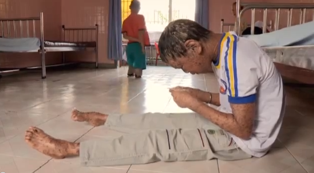 fiskhud, Kina, Sjukdom, Fiskpojken, Hud